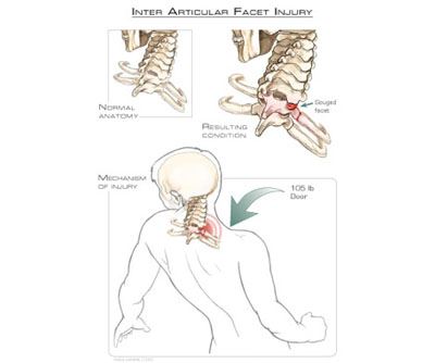 Facet Injury