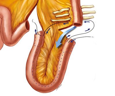 Urinary Diversion